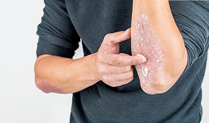Psoriasis